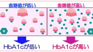 プレドニンとインスリンの減量が与えるHbA1cへの影響